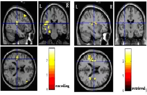 Figure 1Insular cortex activation showed great difference between PTSD and controlsInsular cortex activation showed great difference between PTSD and controls