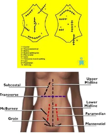 Figure 2: Abdominal incisions 