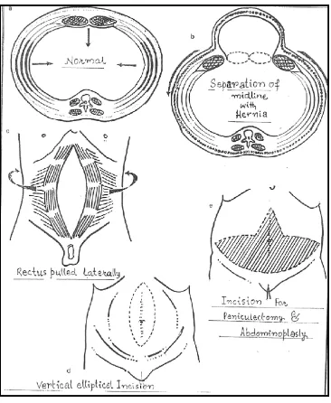 Figure 3: Pathophysiology of incisional hernia 