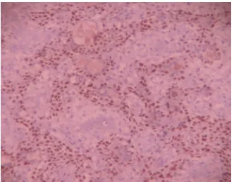 Figure 35. P63 in Plemorphic adenoma myoepithelial cells are positive. (10x). 
