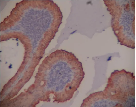 Figure 42.Warthins tumor basal cells are positive for P63(10x). 