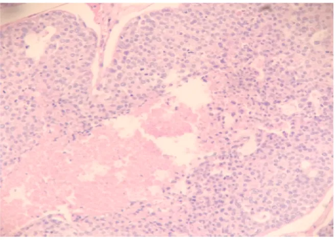 Figure 26.Basal cell adenocarcinoma.microscopy showing  basaloid cells with prominent nucleoli.H&E (10x)