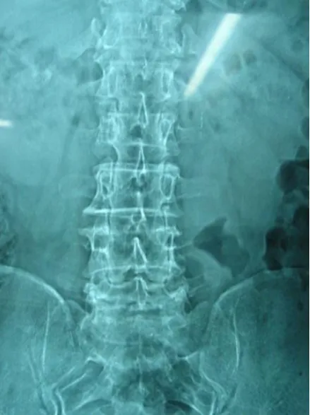 Fig. 8: Antero posterior view 