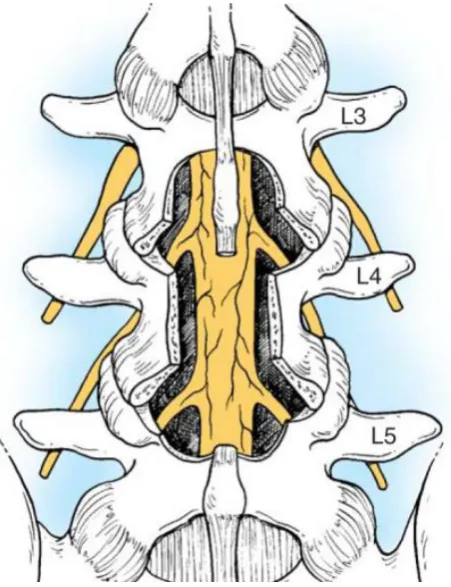Fig-12: Laminectomy 