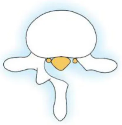 Fig-13: Hemilaminectomy 