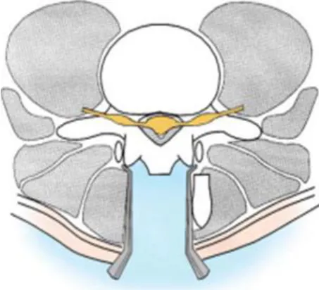 Fig-16: Spinous process osteotomy 