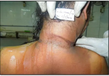 Fig. 11 Showing contusion in the muscles of the neck