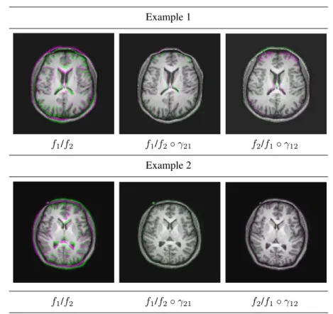 Figure 1.13 Two examples of brain MR image registration (each row as an example). First column shows overlapped original images f 1 and f 2 ; second column shows overlapped images f 1 and deformed f 2 ; third column shows f 2 and deformed f 1 .