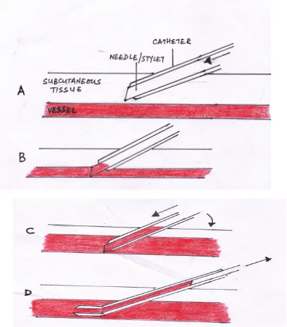 Figure 2: Direct technique of percutaneous arterial cannulation. A- The catheter with the 