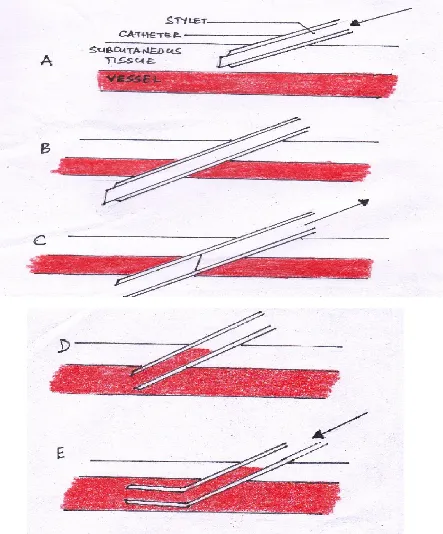 Figure 3:Transfixion technique. A-  The catheter with the stylet is passed through the skin 