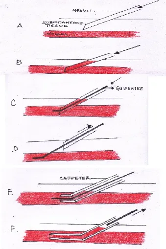 Figure  4:The  Seldinger  technique.  A-  The  needle  is  passed  through  the  skin  and 
