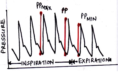 Figure 11: Pulse pressure variation.PP- pulse pressure , PP max – maximum pulse pressure 