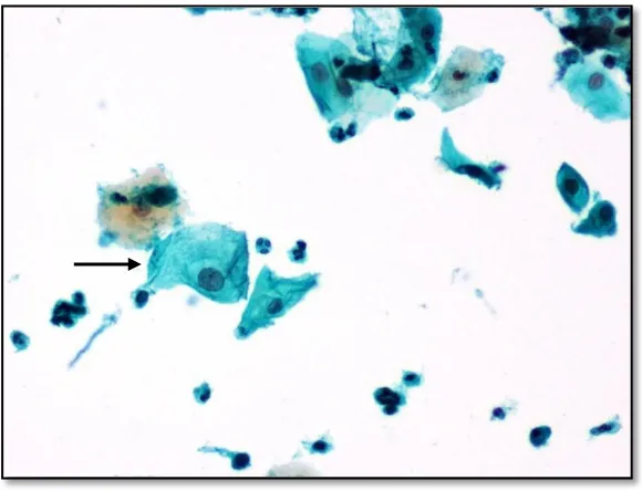 Figure 20: Ectocervical epithelium displaying koilocytosis (H&E,20X) 