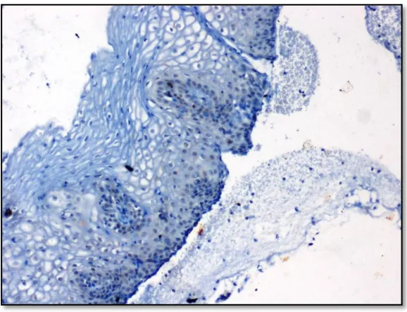 Figure 21: Ectocervical epithelium with koilcytosis (H&E,10X) 