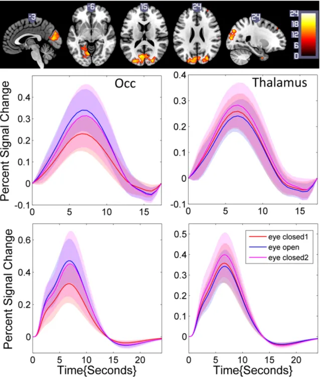 Figure 2.10: Statistical differences in HRF height with eyes closed (1), open, then closed again (2) (top), and typical shapes in the occipital (left) and thalamic (right) area (middle: sFIR;