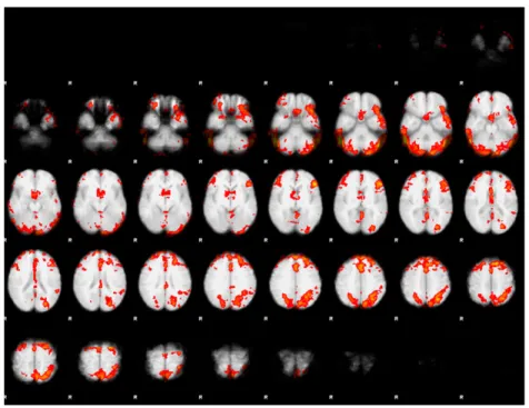 Figure 7. The average of group on 12 patients by joint detection estimation method based  on functionally homogenous regions for optimal contrast (craving>neutral).