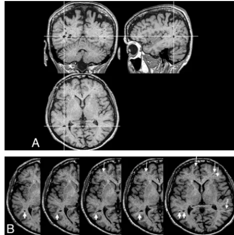 Fig 1. 3D T1-weighted images from 1 participant showing multiple dVRS.dVRS are analyzed on axial, coronal, and sagittal planes.shape and orientation along cortical medullary arteries (matter