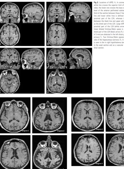 Fig 4. Severity scores of dVRS in the WM.