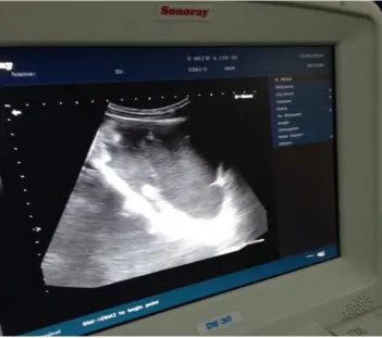 Fig 2: free fluid in Morrison‟s pouch 