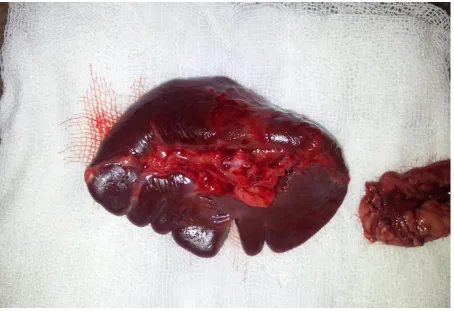 Fig 8: Splenic hilar tear 
