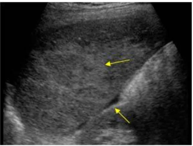 Fig 9: FAST showing liver injury 