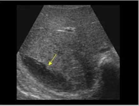 Fig 10: subscapular hematoma liver 
