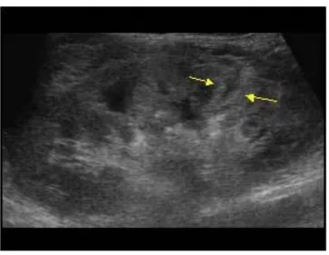 Fig 11: FAST showing Renal Laceration 