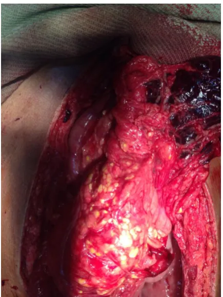 Fig 13: Zone I Retroperitoneal Hematoma 