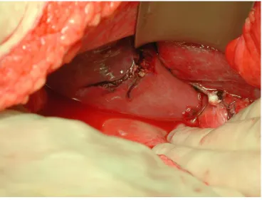 Fig 15: Liver laceration on laparotomy 