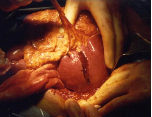Fig 17: Splenic laceration 