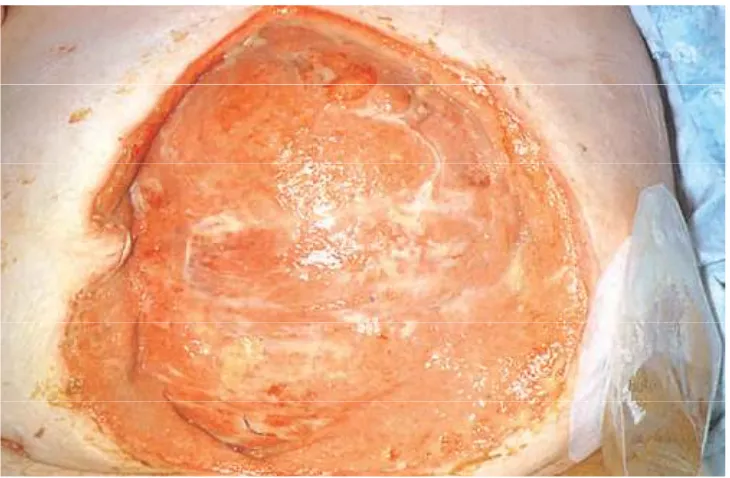 Figure: 15 Faecal peritonitis in which wound left  