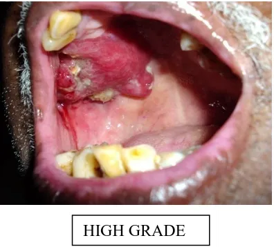 FIGUR-2.-MUCOEPIDERMOID CARCINOMA 