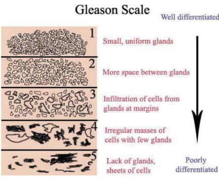 Figure 1.4 Gleason Scale (image courtesy – Wikimedia.org). 