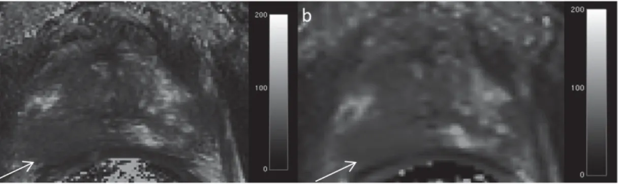 Figure 2.2  T 2 -maps of the prostate using (a) T 2 -TSE (Turbo Spin Echo) (b) T 2 -SEMC  (Spin Echo Multi Contrast) methods