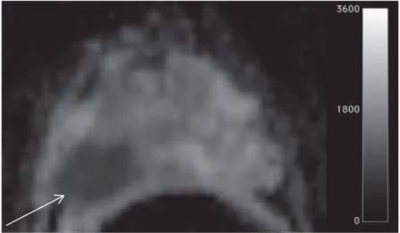 Figure 2.4  Apparent Diffusion Coefficient (ADC) map of the prostate. This image was  obtained with a diffusion weights (b) of 50, 400 and 800 s/mm 2 