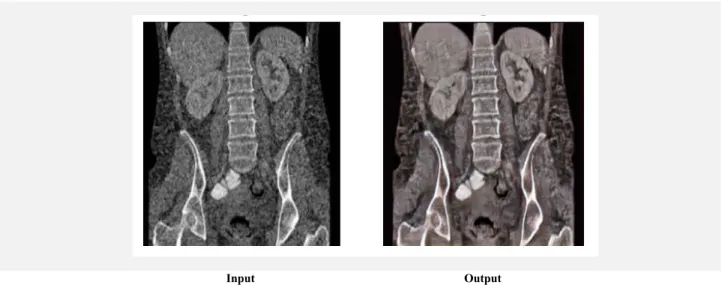 Figure 6. Here we show a resulting denoised output image using our approach, here using a test CT-scan (which our network was not trained on)