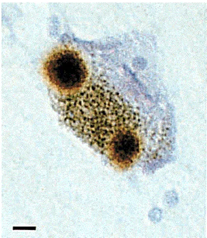 Figure 1. Alpha-synuclein-positive Lewy bodies. Post mortem tissue from the substantia nigra of Parkinson’s disease patients was stained for alpha-synuclein (brown)