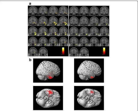 Fig. 1 Brain regions with low gray matter volume in the forensic group. The initial voxel threshold: uncorrected p = 0.001, the cluster-level FWEcorrection, and a cluster-corrected p(FWE) < 0.05