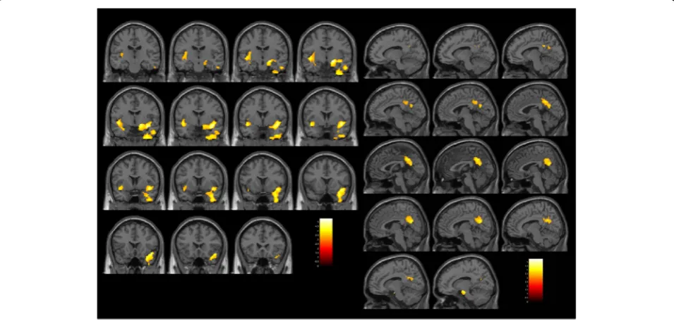 Table 3 Gray matter volume redunction in the impulsive group and the premeditated action group, compared with the controlgroup