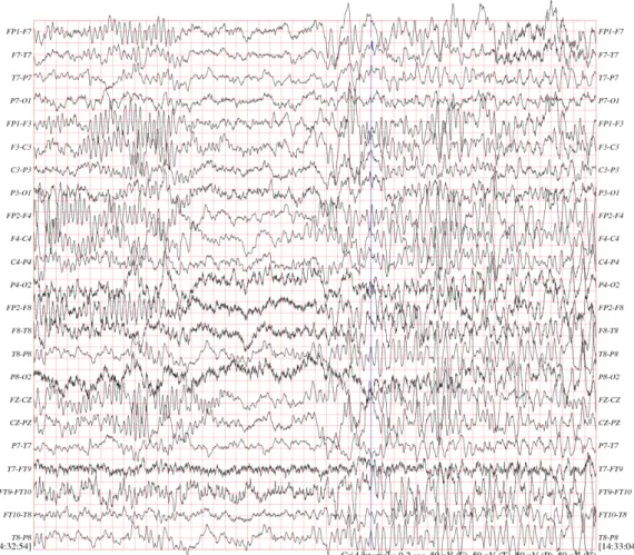 Figure 1.2: Example EEG showing the electrical activity of the brain of a pediatric subject suffering from epileptic seizures [45].