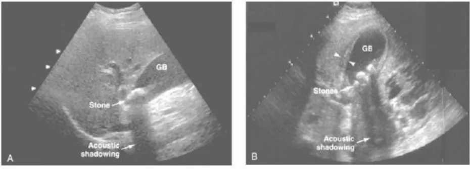 Figure 20(A): Typical ultrasonographic appearance of gallstones casting an acoustic shadow