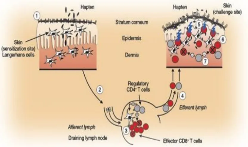 Fig 3 Pathogenesis of Allergic Contact Dermatitis 