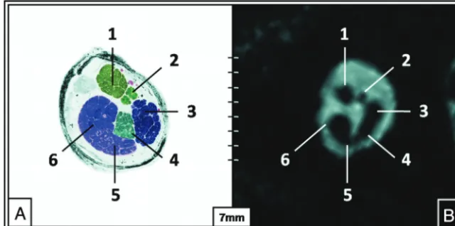 Fig 3. The intermediate position of the NI in the middle third of the IAC (TR, 12.18 ms; TE, 6.09 ms; flip angle, 50°)