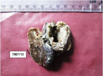 Fig 14: Total Thyroidectomy specimen C/S- Cyst with mural nodule- Papillary carcinoma thyroid 