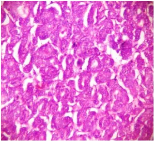 Fig 26: Clear cell change in papillary carcinoma thyroid. H&E x 10 