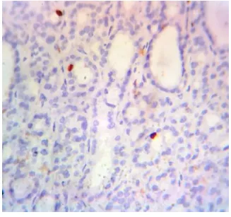 Fig 31: 6-10% of nuclear positivity of  Ki-67 expression in Follicular adenoma. x 40 