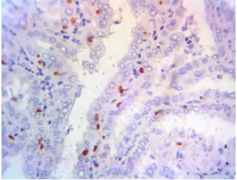 Fig 36: 100% negative staining of p53 in Nodular colloid goiter and Hashimoto thyroiditis