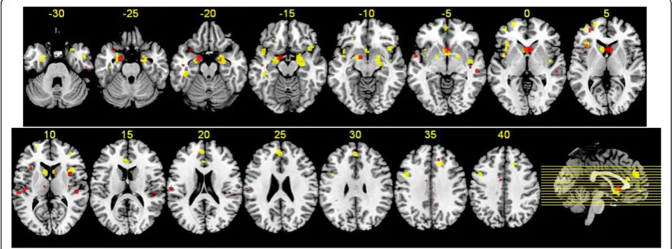 Figure 2 Regions of gray matter change in FES and FTLD subjects. Regions of gray matter decreases in FES subjects compared with controls(red), regions of gray matter decreases in FTLD subjects compared with controls (yellow), and overlapping regions of gra