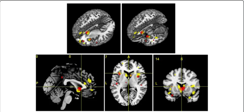 Table 2 Regions of gray matter decreases in FES and FTLD subjects compared with controls (Continued)