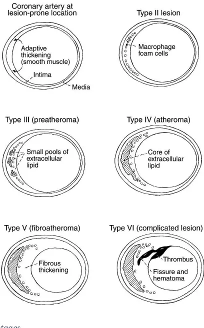 Figure 9 atherosclerosis stages